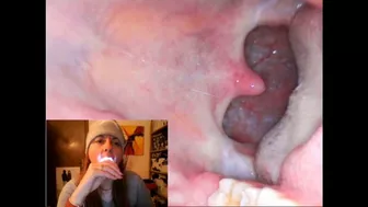 Endoscopy Catarrh Saliva And Mouth Exploration 1080Hd