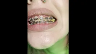 Food Chewing By Braces